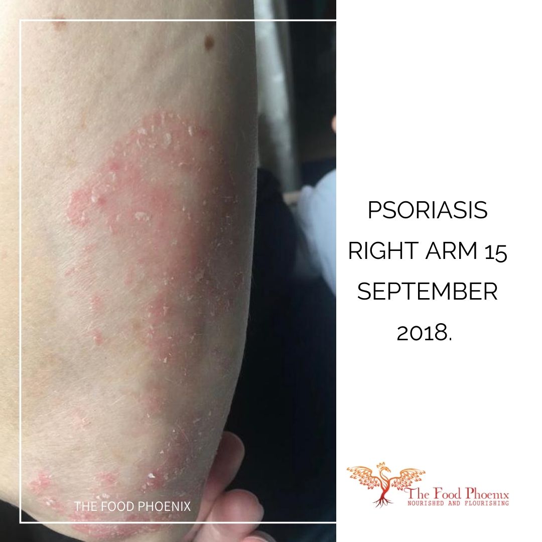 psoriais right forearm 15:9:18 when she was less tired all the time – size of psoriasis lesion has shrunk, pink, a little less scaly