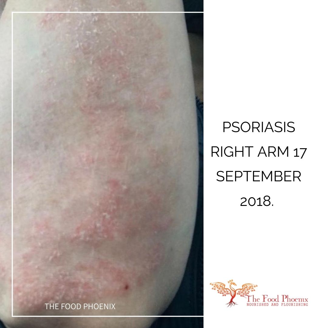 psoriasis right forearm 17:9:18 when she was less tired all the time – Similar to previous image but slightly improved