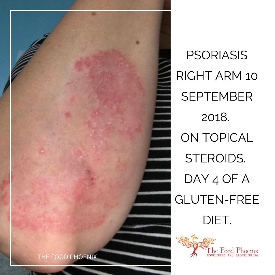 psoriasis right forearm 10:9:18 when she was tired all the time – red, angry, scaly and widespread