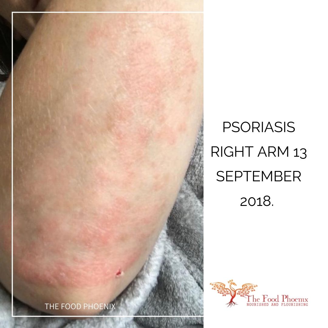 psoriasis right forearm 13:9:18 when she was tired all the time – much less red and scaly