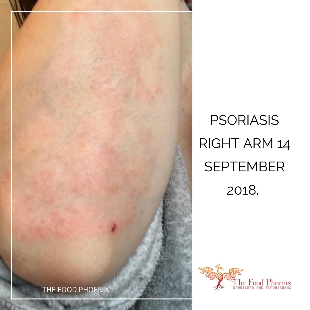 psoriasis right forearm 14:9:18 when she was less tired – pink and no longer red, less scaly