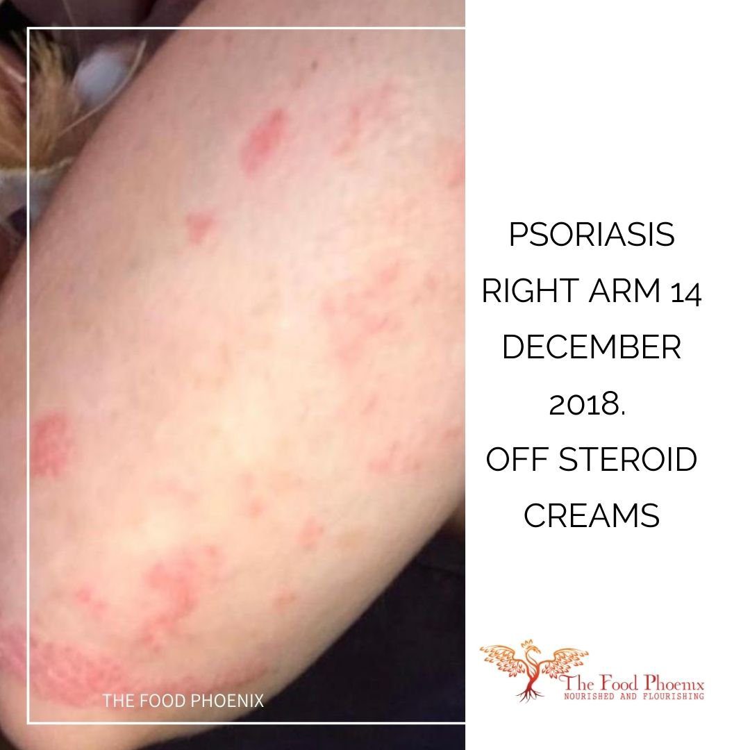 psoriasis 14:9:18. Off steroid creams