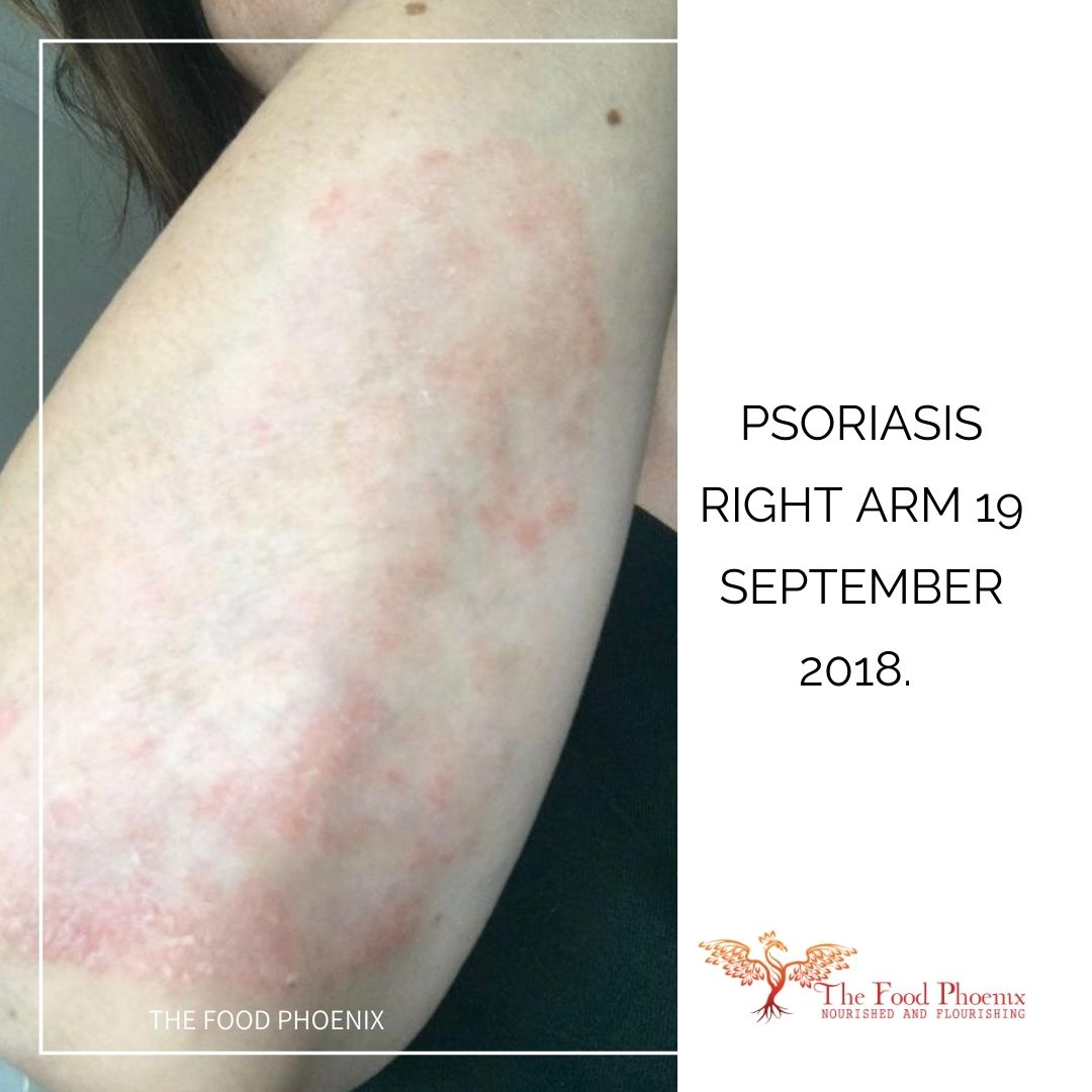 psoriasis 19:9:18 when she was less tired