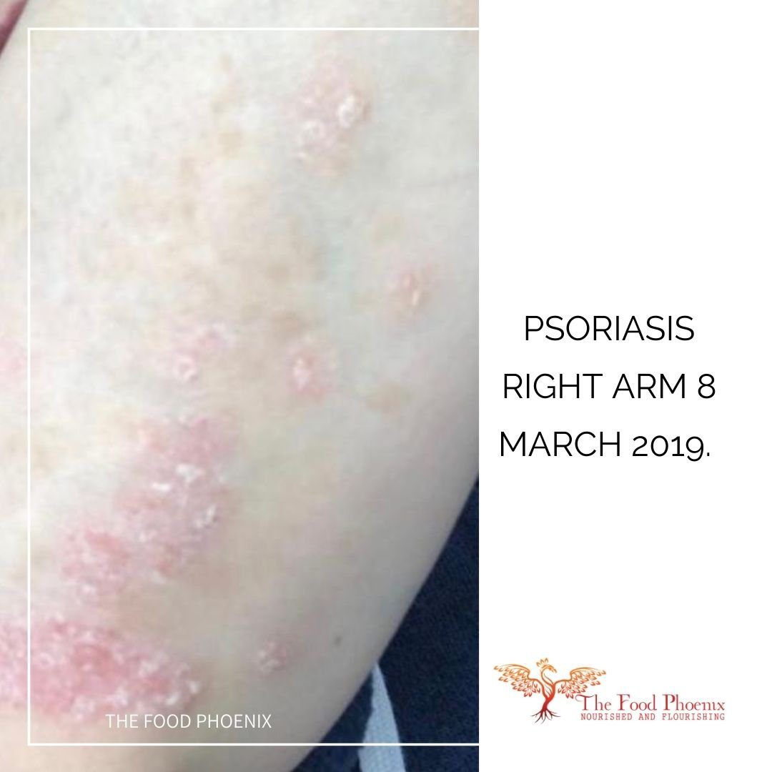 psoriasis right forearm 8:3:19. Still much better – mostly normal skin with some patches of psoriatic plaques