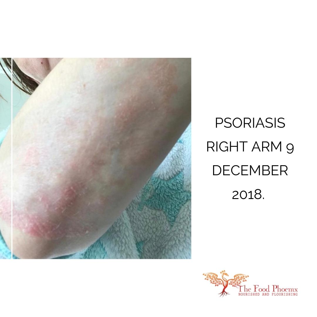 psoriasis 9:12:18 when her energy levels were improving – much fainter than the first images